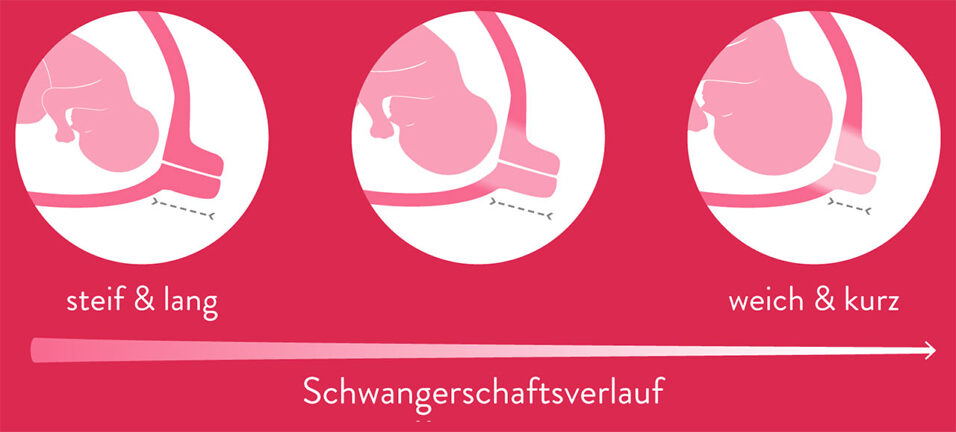 Diagramm Frühgeburtserkennung